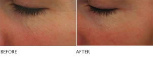 Clarisonic reduces the appearance of fine lines and wrinkles