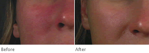 Clarisonic Healthier Skin Before & After Photos