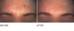 Clarisonic Sonic Cleansing Systems improves the appearance of healthy skin