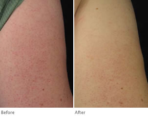 Clarisonic Skin Texture- Before and After Photos