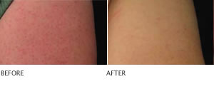 Clarisonic with Body Brush improves the appearance of skin texture