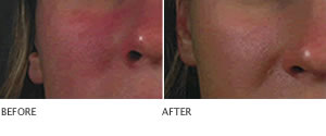 Clarisonic Sonic Cleansing Systems improves the appearance of skin tone