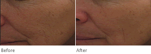 Clarisonic Fine Lines & Wrinkles- Before and After Photos
